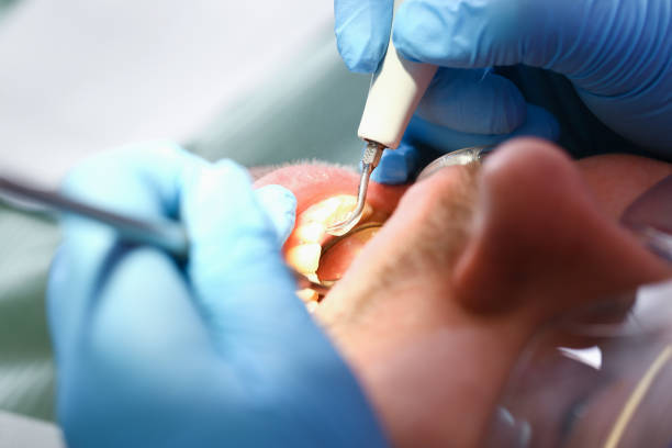 Best Dentist for Tooth Abscess  in Junction, TX